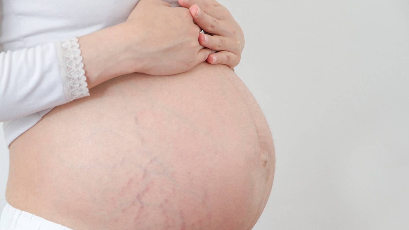 Pregnancy stretch marks