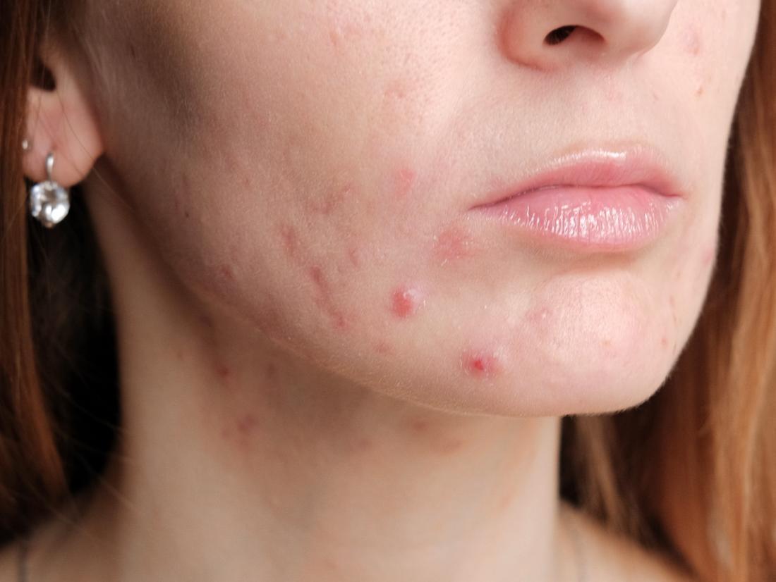 a-woman-with-pregnancy-acne