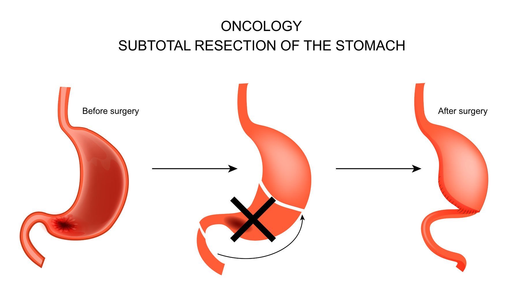 stomach-cancer-procedure